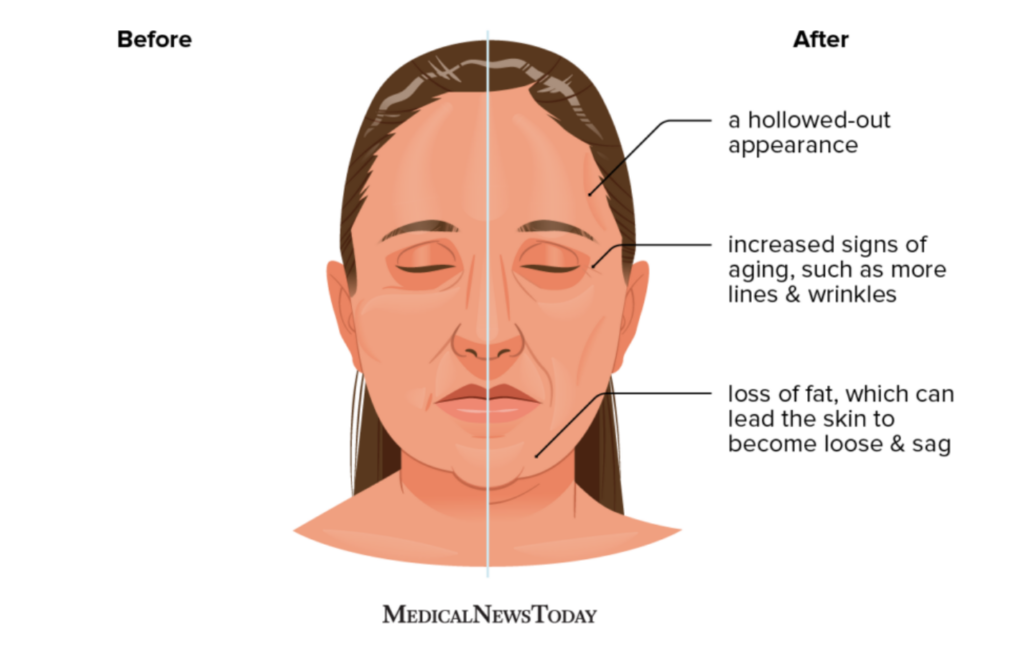 Illustration effects of Ozempic face with before and after portions of face noted. 